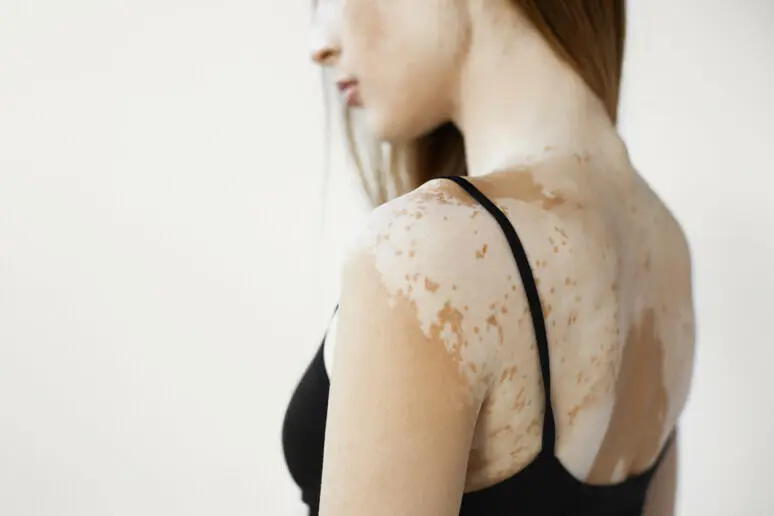 corpo affetto da vitiligine