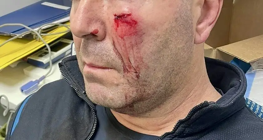 L’agente ferito al volto