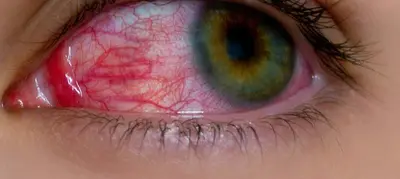 Occhio con distacco della retina