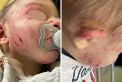 Gabriele dopo essere stato morso