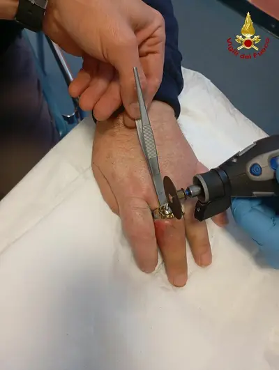 anello incastrato
